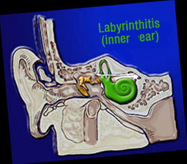 Labyrinthitis...